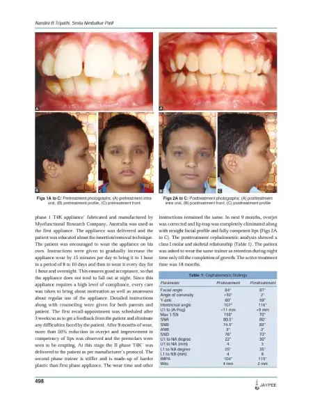 Treatment of Class II Division