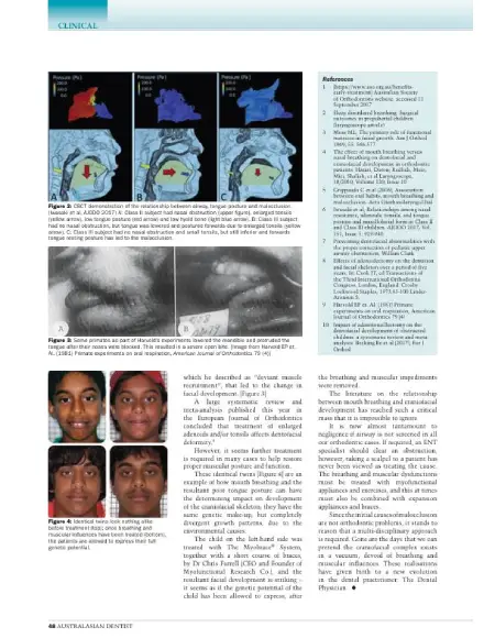 mouth-breathing-part-ii