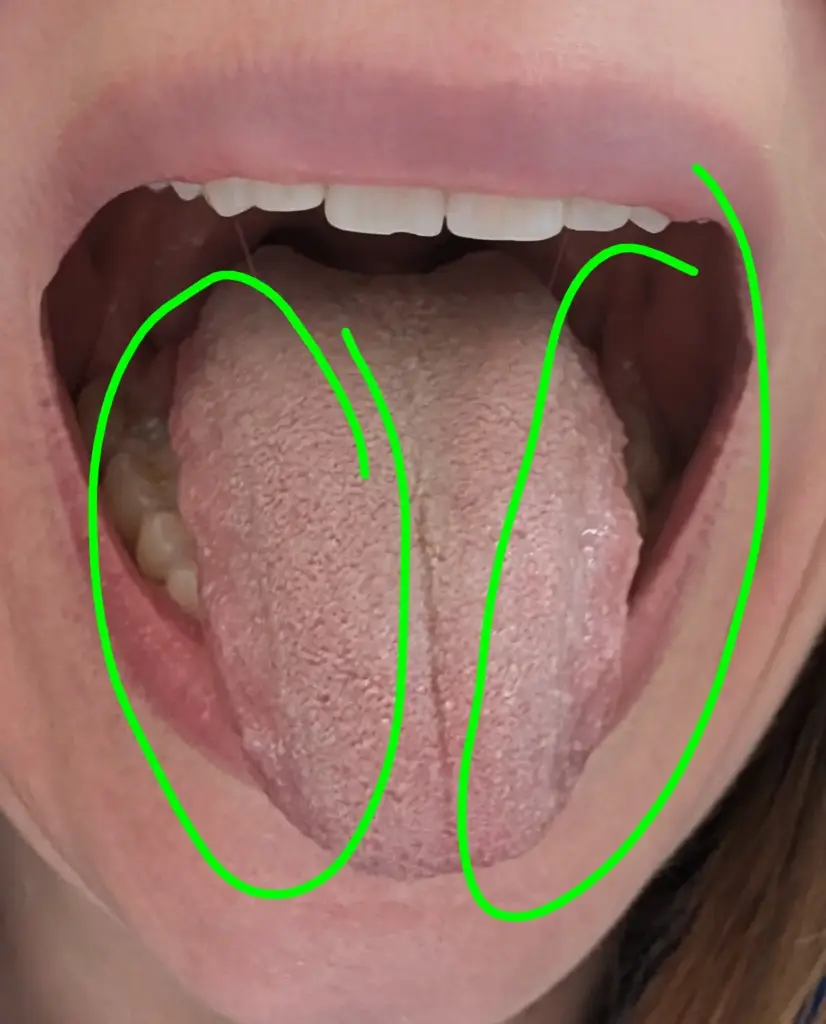 clinical photo of scalloped tongue